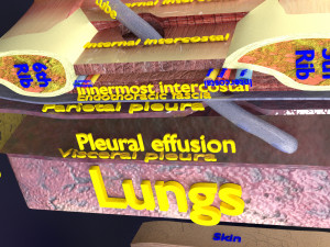 3D thoracic procedures Modelo 3D