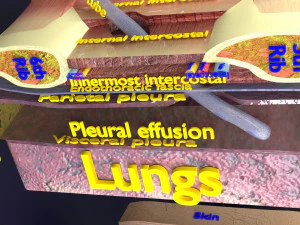 3D thoracic procedures 3D Model