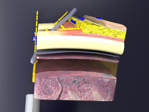 3D thoracic procedures Modelo 3D