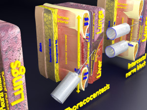 3D thoracic procedures Modelo 3D