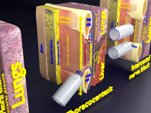 3D thoracic procedures 3D Model