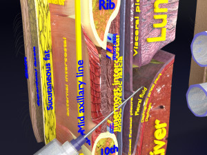 3D thoracic procedures Modelo 3D