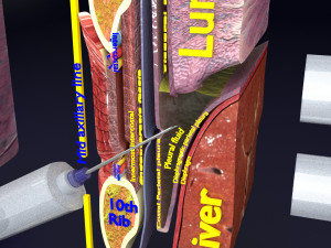3D thoracic procedures Modelo 3D