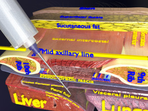 3D thoracic procedures Modelo 3D