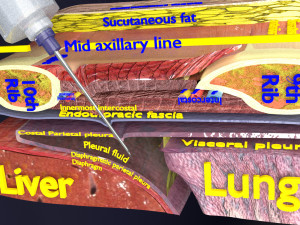 3D thoracic procedures Modelo 3D