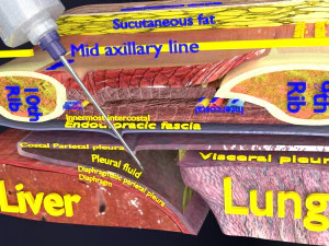 3D thoracic procedures 3D Model