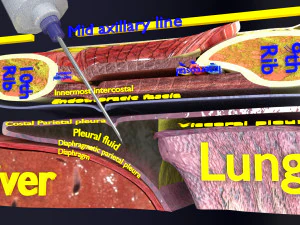 3D thoracic procedures 3D Model