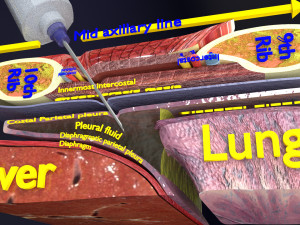 3D thoracic procedures Modelo 3D