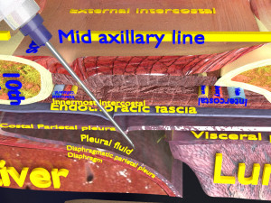 3D thoracic procedures Modelo 3D