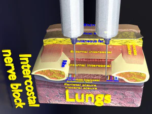3D thoracic procedures 3D Model
