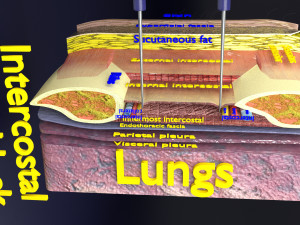 3D thoracic procedures Modelo 3D