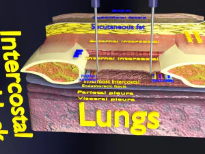 3D thoracic procedures 3D Model