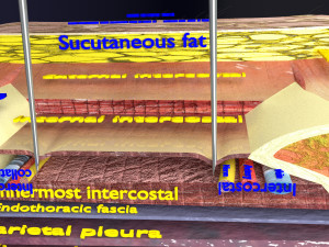 3D thoracic procedures Modelo 3D