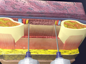 3D thoracic procedures Modelo 3D