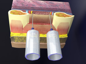3D thoracic procedures Modelo 3D