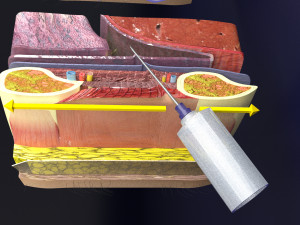 3D thoracic procedures Modelo 3D