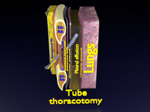 3D thoracic procedures Modelo 3D
