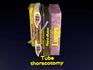 3D thoracic procedures 3D Model