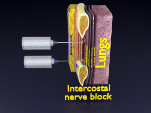 3D thoracic procedures Modelo 3D