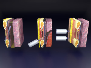 3D thoracic procedures Modelo 3D