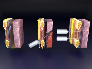 3D thoracic procedures 3D Model