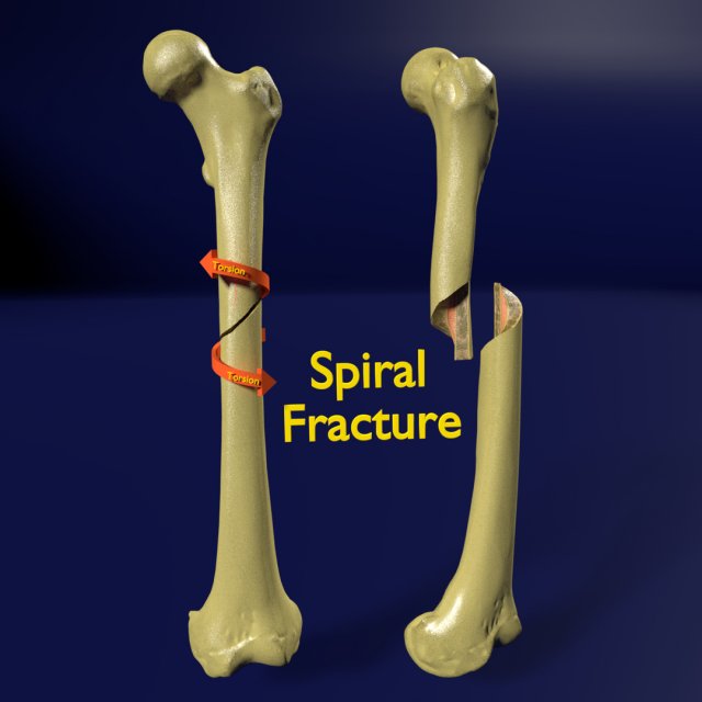 Spiral Fracture skeleton labelled femur 3D Model .c4d .max .obj .3ds .fbx .stl .blend 