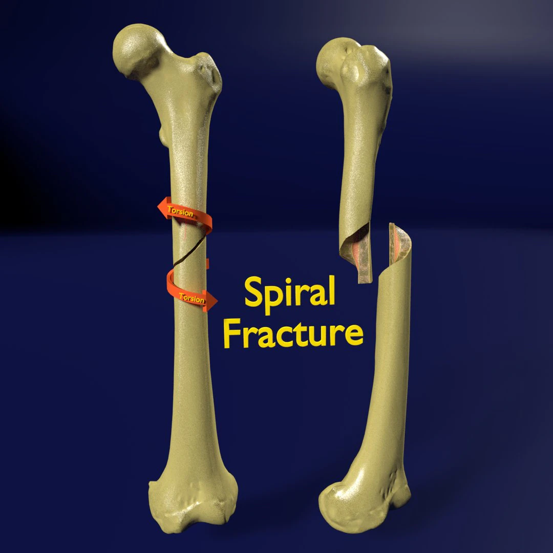 Spiral Fracture skeleton labelled femur 3D Model .c4d .max .obj .3ds .fbx .stl .blend 