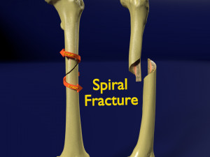 Spiral Fracture skeleton labelled femur 3D Model