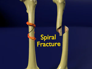Скелет спирального перелома с надписью "бедренная кость" 3D Модель