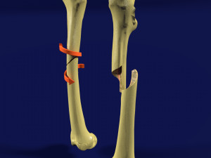 Spiral Fracture skeleton labelled femur 3D Model