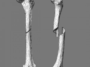 Spiral Fracture skeleton labelled femur 3D Model