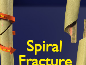 Spiral Fracture skeleton labelled femur 3D Model