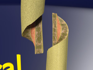 Spiral Fracture skeleton labelled femur 3D Model
