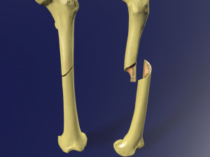 Spiral Fracture skeleton labelled femur 3D Model