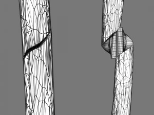 Spiral Fracture skeleton labelled femur 3D Model