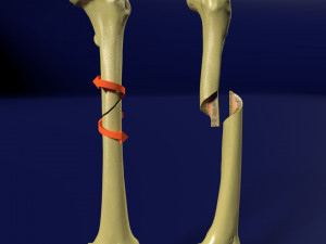 Spiral Fracture skeleton labelled femur 3D Model