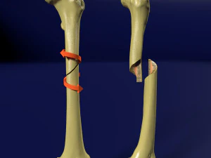 Spiral Fracture skeleton labelled femur 3D Model