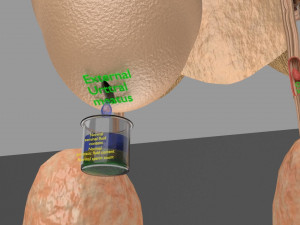 Seminal fluid according to cause of azoospermia 3D 模型