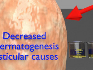 Seminal fluid according to cause of azoospermia 3D 模型