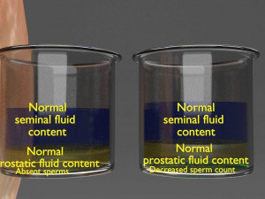 Seminal fluid according to cause of azoospermia 3D 模型