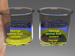 Seminal fluid according to cause of azoospermia 3D 模型