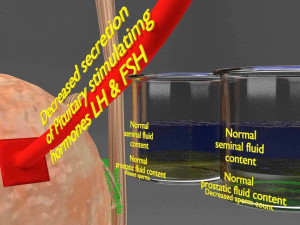 Seminal fluid according to cause of azoospermia 3D 模型