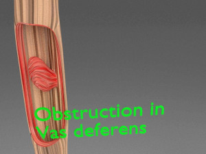 Seminal fluid according to cause of azoospermia 3D 模型