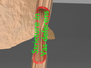 Seminal fluid according to cause of azoospermia 3D 模型