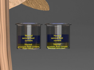 Seminal fluid according to cause of azoospermia 3D 模型