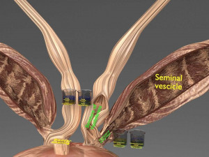 Seminal fluid according to cause of azoospermia 3D 模型