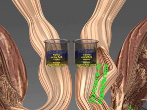 Seminal fluid according to cause of azoospermia 3D 模型
