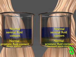 Seminal fluid according to cause of azoospermia 3D 模型