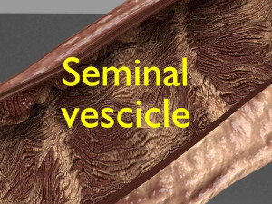 Seminal fluid according to cause of azoospermia 3D 模型