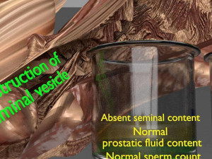 Seminal fluid according to cause of azoospermia 3D 模型